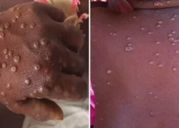 Un an après sa dernière apparition, la maladie virale Mpox refait surface en Guinée. Elle se manifeste notamment par des éruptions cutanées, de la fièvre, des céphalées ainsi que des douleurs musculaires.