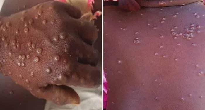 Un an après sa dernière apparition, la maladie virale Mpox refait surface en Guinée. Elle se manifeste notamment par des éruptions cutanées, de la fièvre, des céphalées ainsi que des douleurs musculaires.