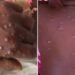 Un an après sa dernière apparition, la maladie virale Mpox refait surface en Guinée. Elle se manifeste notamment par des éruptions cutanées, de la fièvre, des céphalées ainsi que des douleurs musculaires.