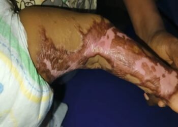 Siguiri : un appel à la solidarité lancé pour sauver la petite Hafsatou, gravement brûlée