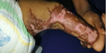 Siguiri : un appel à la solidarité lancé pour sauver la petite Hafsatou, gravement brûlée